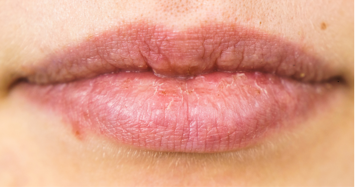 Cold sore blister on lip illustrating HSV-1 virus outbreak and early stages of a cold sore